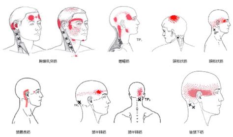 頭痛 位置|専門家が解説！ 頭痛の位置から分かること